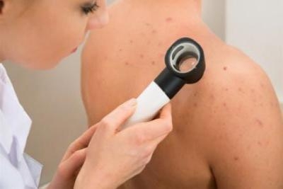 Dermoskopija - proverite sve mladeže na vreme