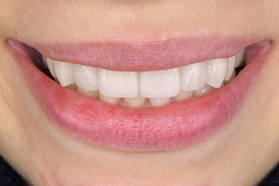 Izrada metalkeramike krunice. Akcija