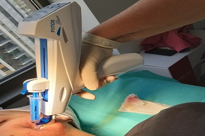 PRP tretman podmađivanja sopstvenom krvnom plazmom - lica ili kose–glave.Akcija